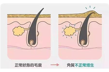 鸡皮肤用va酸软膏