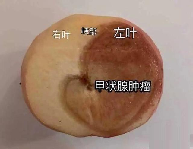 甲状腺结节一二三四级区别 2026年甲状腺结节一二三四级区别大吗