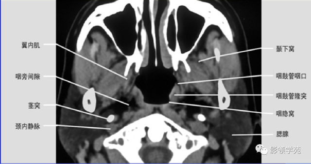 腮腺角化型鳞癌