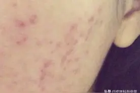 痘痘好了，却留下了很多痘坑痘印，该怎么办？图片