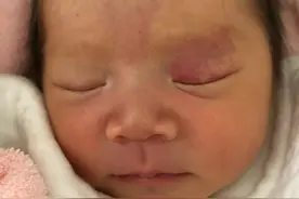 新生儿眼皮上有一片红色的图片