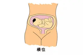 孕妇横位难产，胎儿手先出来了，医生把手塞回去，再把胎儿的腿拽出来图片
