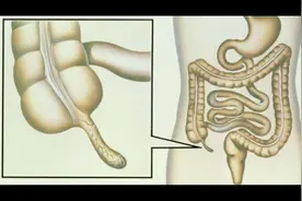 阑尾切除手术图片