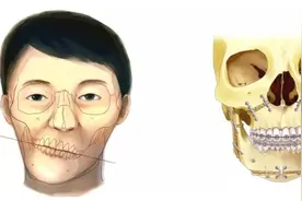 哪些原因导致“歪脸”，应该如何改善？图片