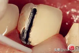 听说做核磁共振前需要把假牙撬掉？医生：并非所有假牙需要！图片