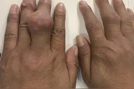 小心痛风被误诊，这七种关节痛也有红肿和热痛的症状，容易被混淆图片