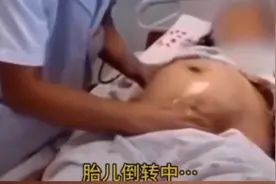 孩子臀位无法顺产，医生徒手将孩子转正，会这个技术的不多了图片