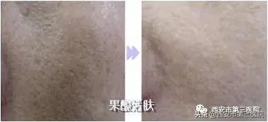 西安治疗鱼鳞病的医院哪家最好
