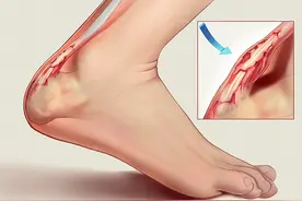 跟腱炎的分析与诊疗图片