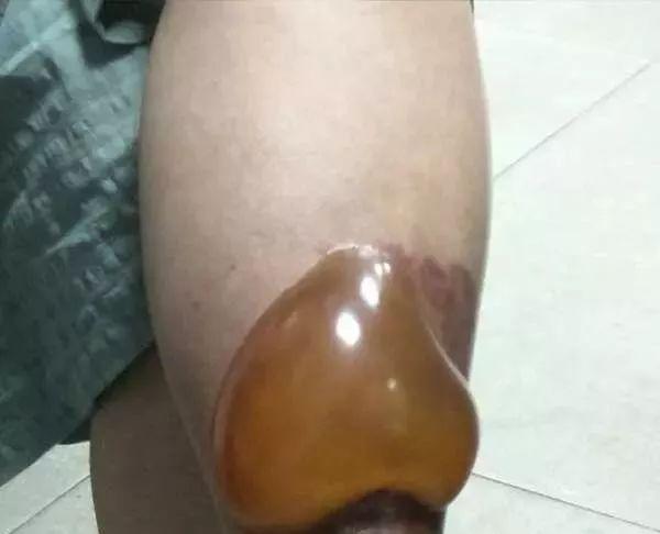 紧急提醒!红火蚁出没漳州!千万别碰!县政府已启动疫情防控