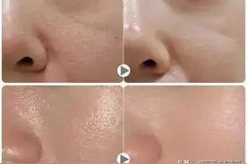 过来人总结：做水光针的5条心得图片