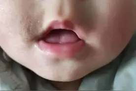 宝宝的胎记要不要去清除？自己带娃的妈妈好难图片