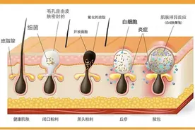 什么样的女生容易“长痘”？从这几点就能判断，希望你不是图片