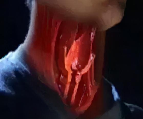 声带过度不全角化