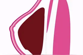 隆乳手术前需要做哪些准备？图片