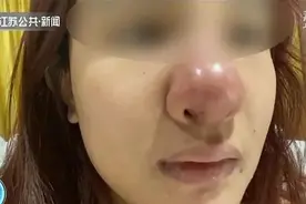 整容后女孩"猪鼻子"照满天飞，她是被毁容了吗？图片