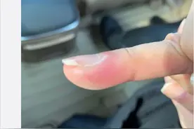 邓萃雯拔指甲倒刺入院，痛得咬紧牙根，劝诫粉丝不要用手拔倒刺图片