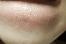 下巴凸起白色的小颗粒是什么？学会这2招快速清除，皮肤细腻光滑图片