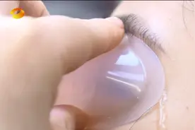 长沙一女子用艾叶煮水洗眼，感染细菌，导致结膜、角膜发炎！医生提醒：切勿随意洗眼睛图片