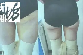 自爆！一个奶爸羞于启齿的抽脂故事，抽脂需谨慎图片