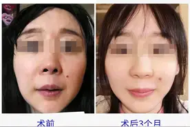 没磨骨，没填充，我只是做了“超微创小切口提升手术”图片