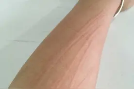 这种是人工荨麻疹，治疗人工荨麻疹记住这3点图片