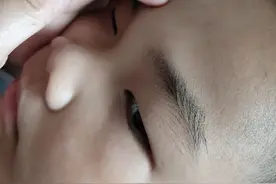 手术切除晕痣恢复过程，什么时候能恢复正常肤色？图片