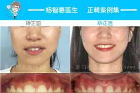 厦门牙齿矫正：少一颗虎牙也能拥有好看笑容哦图片