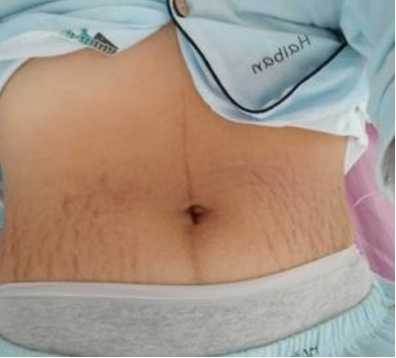 尿素身体乳含激素吗