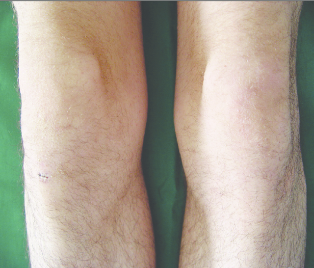 角化过度角化不全炎症