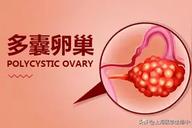 多囊卵巢综合征对试管婴儿有什么影响？图片