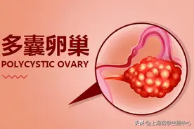 多囊卵巢综合征对试管婴儿有什么影响？图片