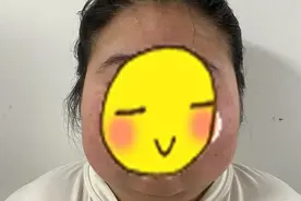 25岁妙龄女子肥胖、弓背、长痘痘，长胡子，竟是垂体瘤在“作怪”图片