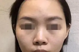 韦敏精讲丨鼻孔暴露过多不美观，应该如何改善图片