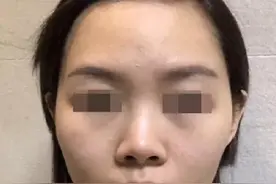 韦敏精讲丨鼻孔暴露过多不美观，应该如何改善图片