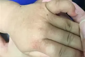 地上爬一会，皮炎找上身——广安门医院儿童健康科普周图片