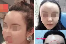关于自体脂肪填充，那些整形医生不会告诉你的图片