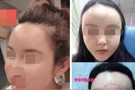 关于自体脂肪填充，那些整形医生不会告诉你的图片