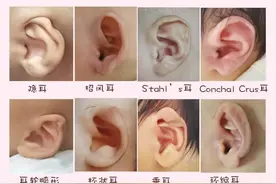 “招风耳”是新生儿的一种耳廓形态畸形，需及时矫正图片