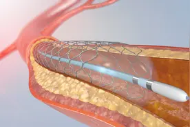 装了支架是不是"一劳永逸"？来看心脏支架那些事儿图片