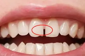 冲牙器到底是不是智商税？看这篇就够了图片