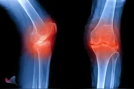 大二男生骨质疏松比老年人还严重！年纪轻轻就骨质疏松，这些习惯必须改图片