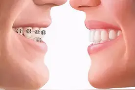 正畸堪比整容？成年人可以正畸吗？牙齿矫正的8个问题一次说清图片