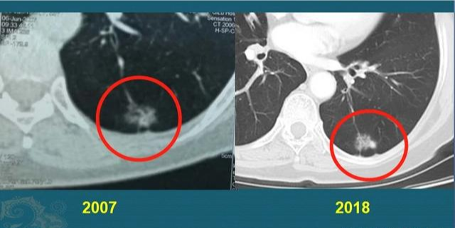 非角化型鳞癌胸腺