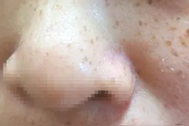 脸上常见的6种斑，看看自己的斑是属于哪一种吧？图片