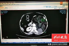 罕见！桂林女子腹部长8斤大肉瘤！原以为上了年纪身宽体胖图片