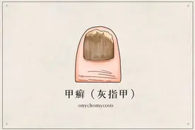 得了灰指甲，一个传染俩，治灰指甲该如何用药？​丨药师说药图片