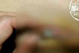男童身上溃烂穿孔，还不敢告诉家长！直到清洗内裤时才发现血渍图片