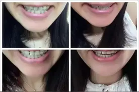 戴牙套后我爱牙如命之洗牙记图片
