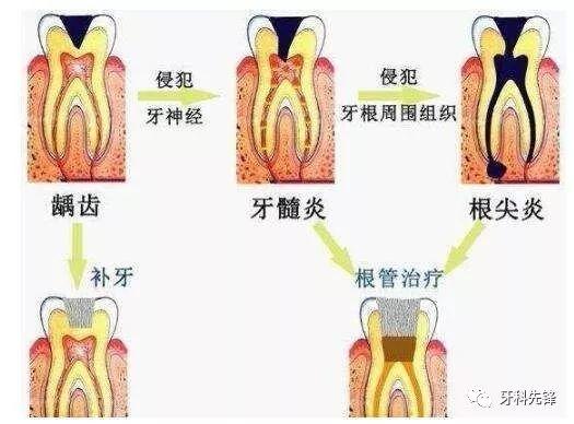 根管治疗的收费标准原来是：难度=费用
